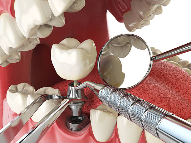 Best Emergency Wisdom Tooth Extraction in Oakland, NJ